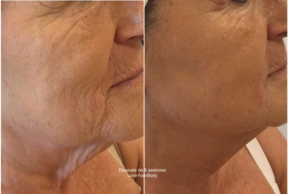 Tratamiento facial Fhos Procyon en Love Your Body, Barcelona: antes y después