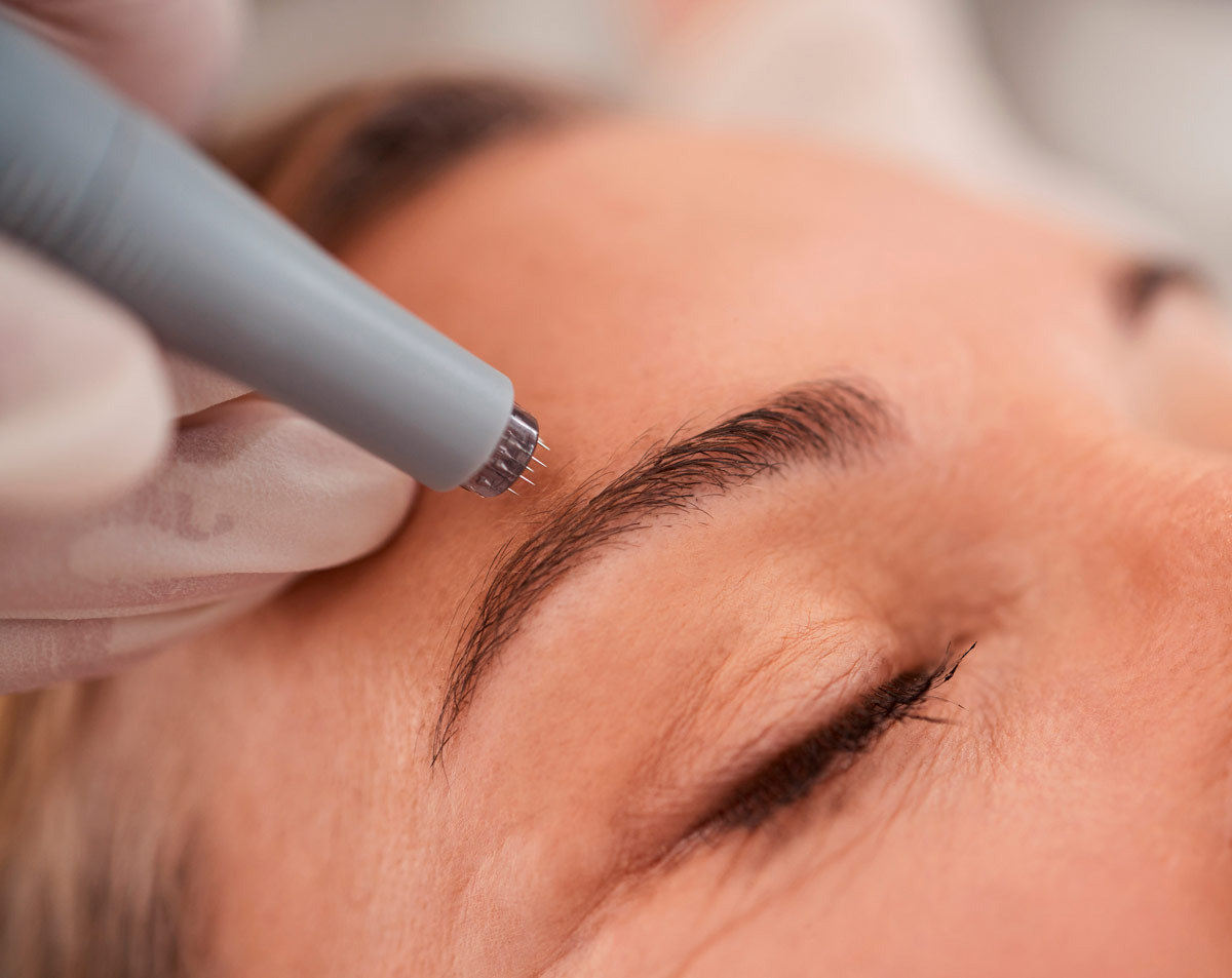 Tratamiento de microneedling con microagujas en Love Your Body, Barcelona