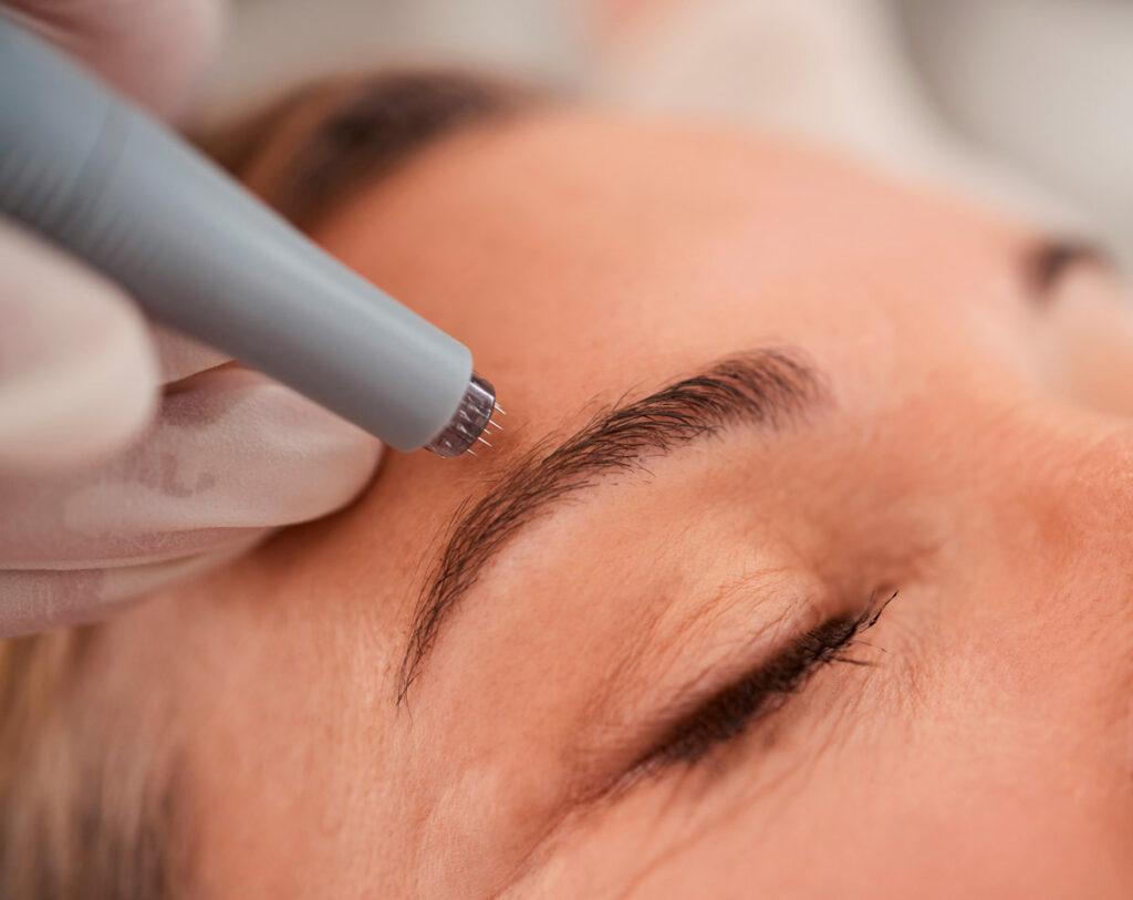 microneedling tratamiento facial microagujas 1