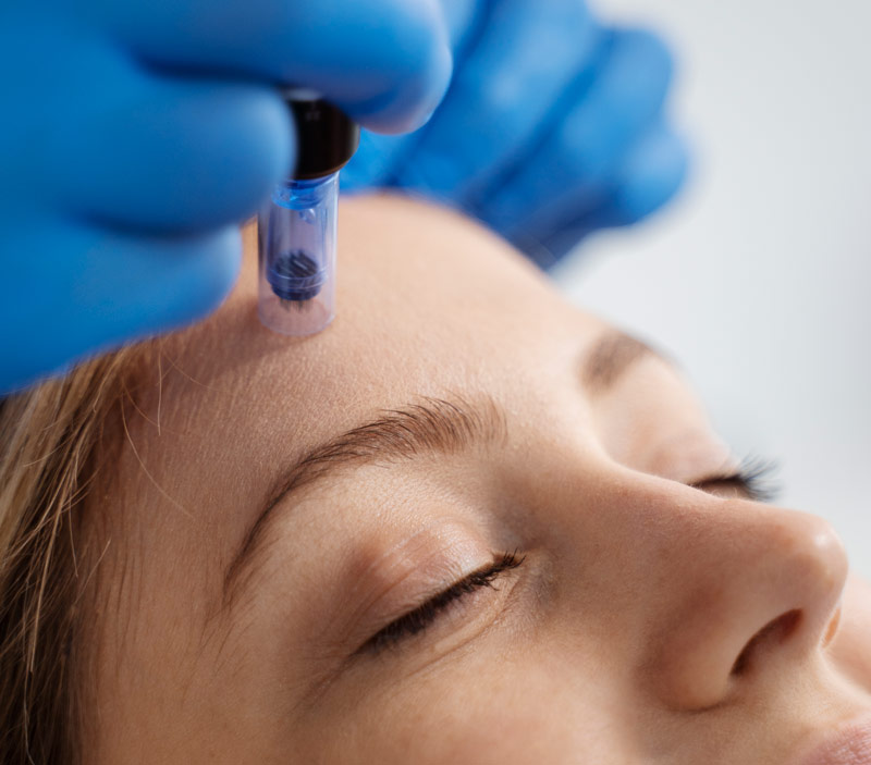 microneedling Barcelona, microagujas facial
